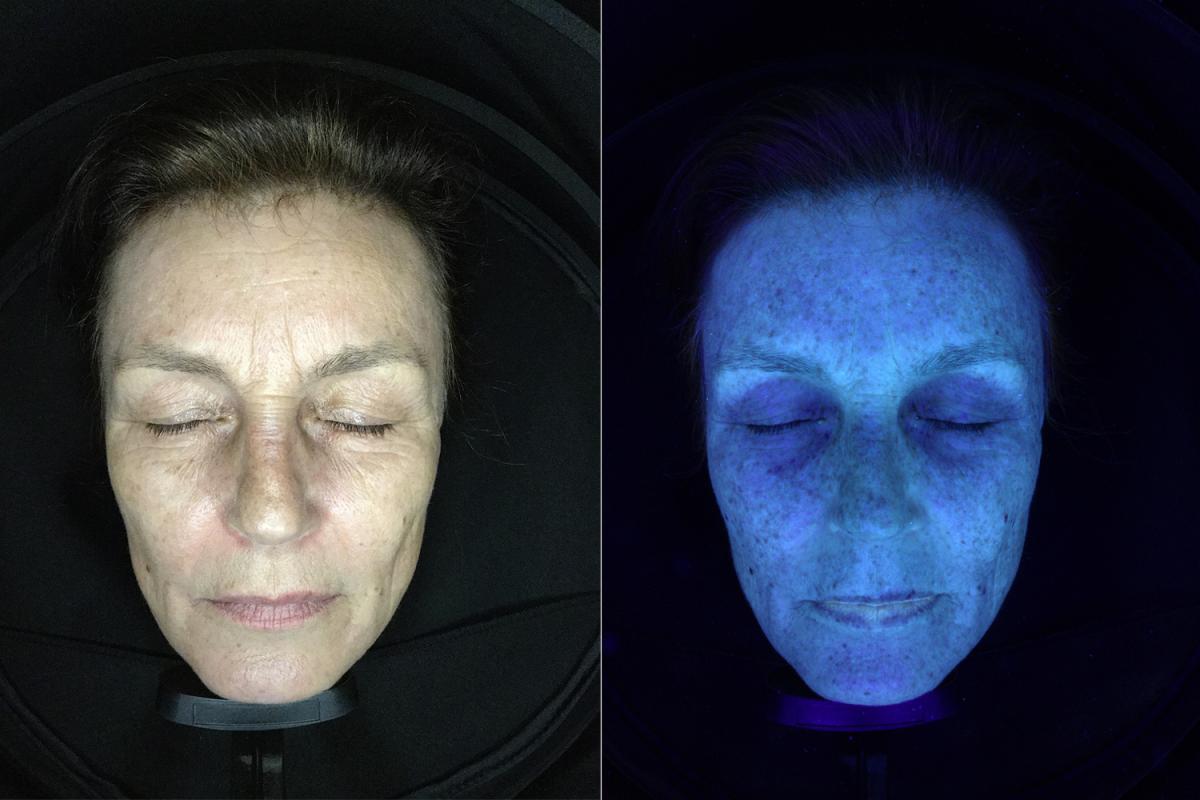 Bild vom Gesicht einer Frau, das im Rahmen der Hautanalyse mit Tageslicht und UV-Licht bestrahlt wird